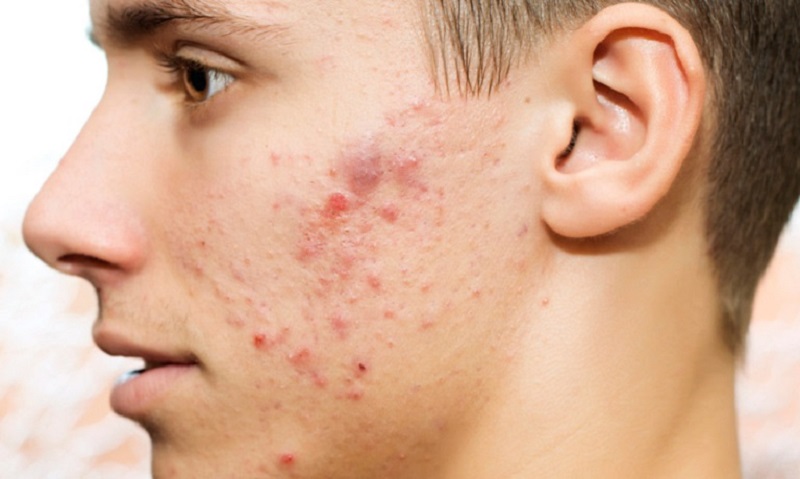 Mụn nội tiết tố xuất hiện nhiều trên mặt, lưng và vùng ngực